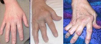 gout damage